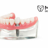 Single Tooth Dental Implants