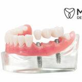 Implant Supported Bridge