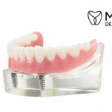 Implant Dentures