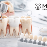 Dental Filling